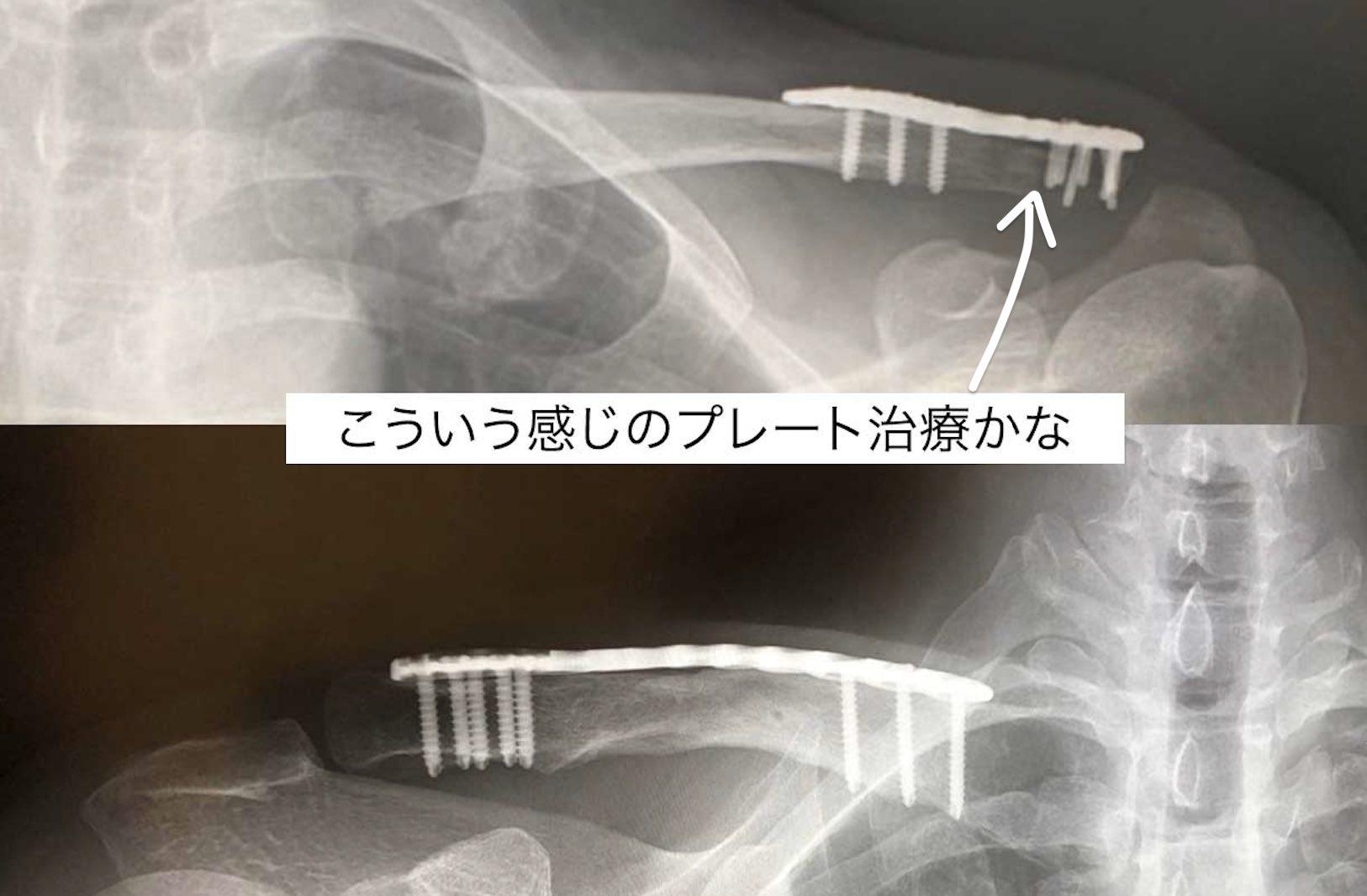 藤田菜七子の落馬と鎖骨骨折の治療法